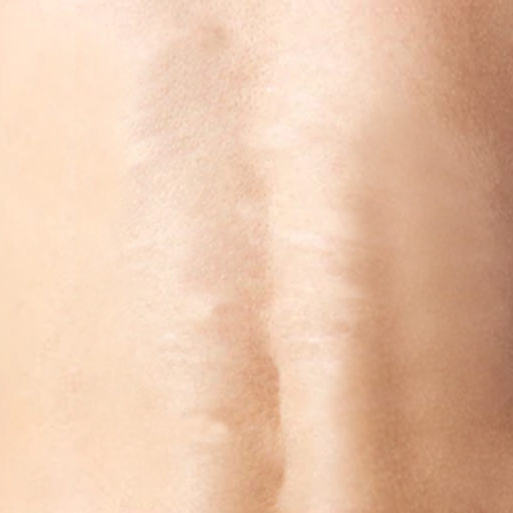 Scar Treatment Abu Dhabi Stretch Marks Treatment EWMC