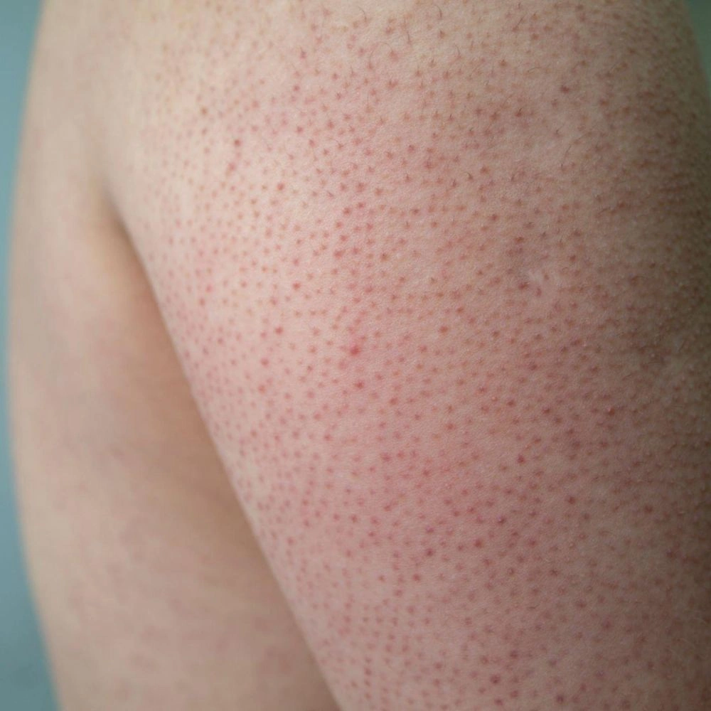 Indication Keratosis Pilaris Everlastwellness