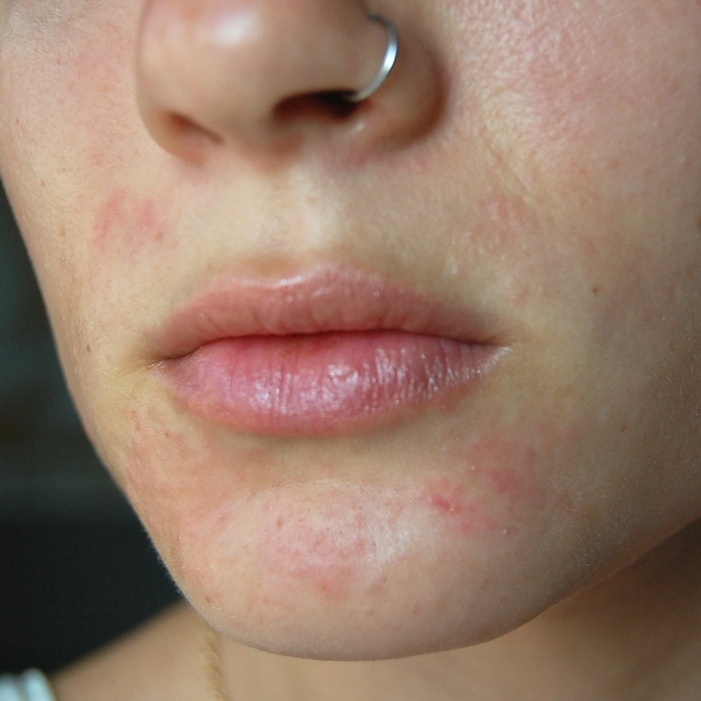 Indication Perioral Dermatitis Everlastwellness 