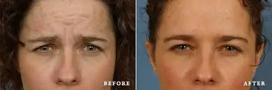 Unlocking the Benefits of Neurotoxin (Botox) for Forehead Rejuvenation: A Comprehensive Guide